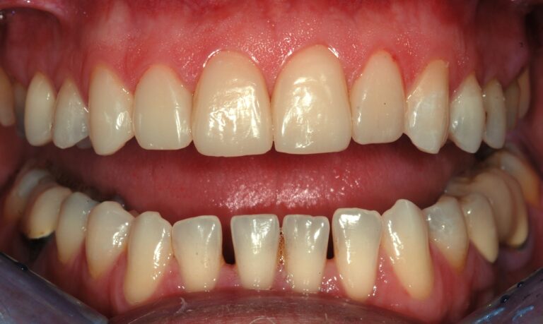FLOW INJECTION DENTALSTYLE (4)